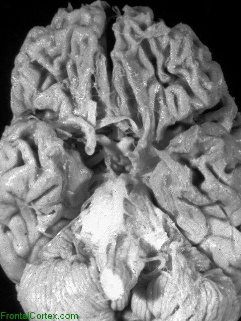 Pick Disease, ventral surface of brain.