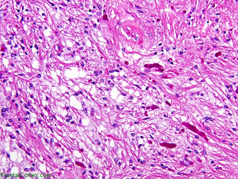 Pilocytic astrocytoma, H&E stain x 200