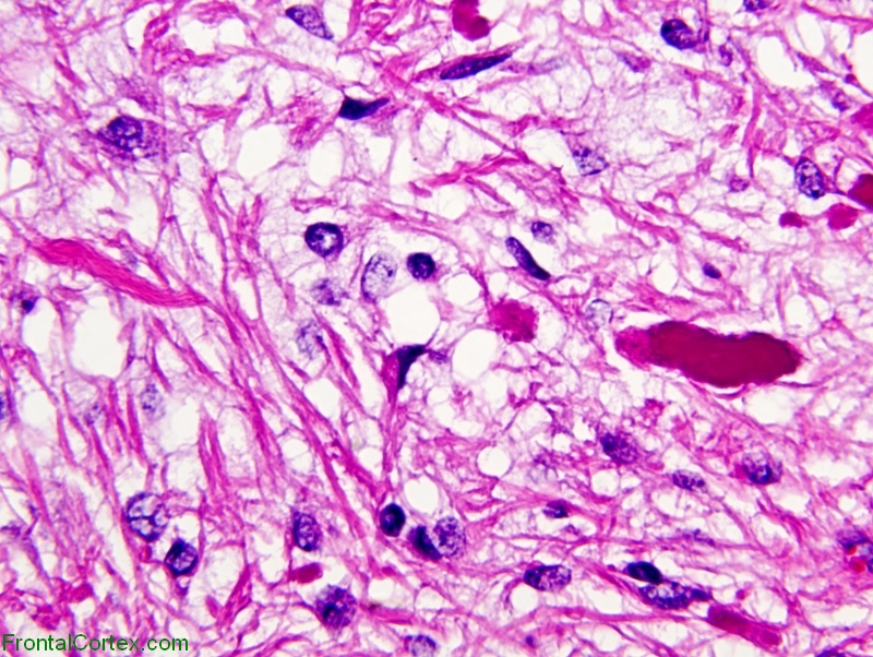 Pilocytic astrocytoma, H&E stain X600