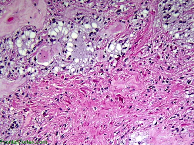 Pilocytic Astrocytoma, H&E stain x 400
