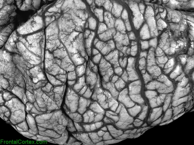 Polygyria, dorsal surface of brain
