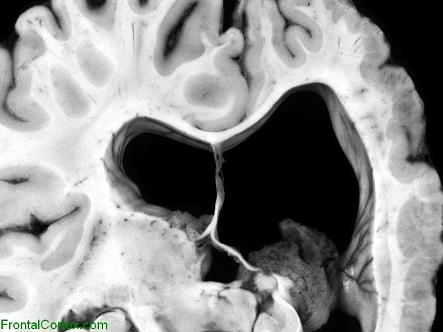 Polymicrogyria, coronal section through brain.