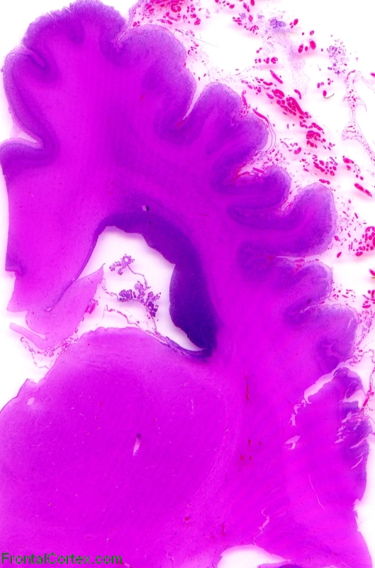 Polymicrogyria, whole mount of coronal section, H&E stain