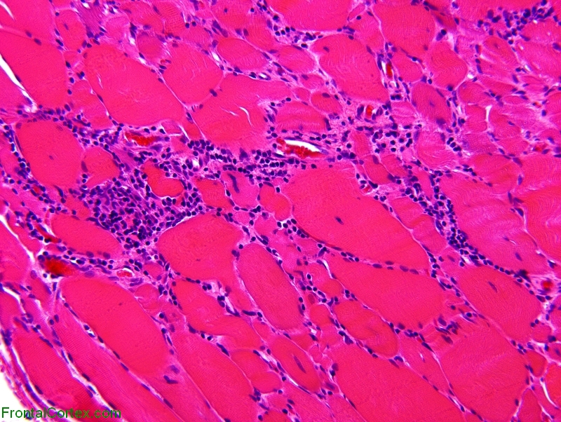 Polymyositis, paraffin-embedded H. E. stained section x 200