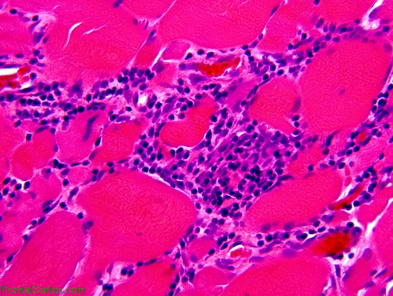 Polymyositis,paraffin-embedded, H&E stained section 400x