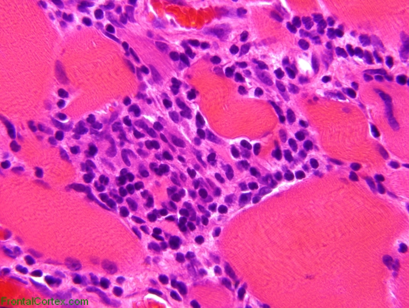 Polymyositis, paraffin-embedded H&E stained section x 600