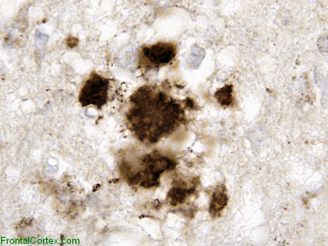 Variant Jakob-Creutzfeldt disease, cerebral cortex, 3F4 immunohistochemical staining x 400