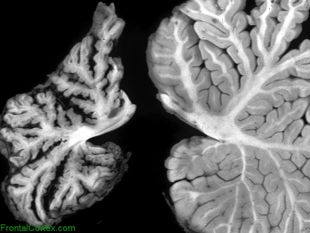Sporadic Jakob-Creutzfeldt disease, VV2 subtype, sagittal section of cerebellum with control cerebellum