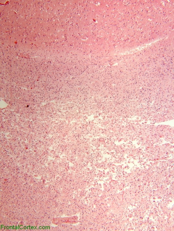 Late-delayed radiation necrosis, low power H&E stain through cerebral cortex and white matter.