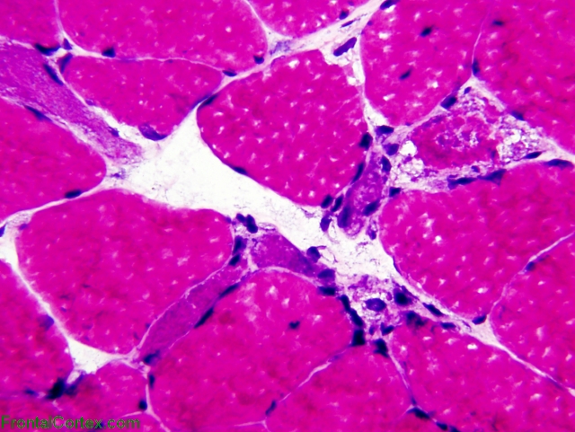 Necrotizing myopathy in a patient with rhabdomyolysis, H&E stained section x 400