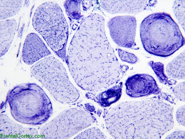 Ring fibers, NADH-TR histochemical staining