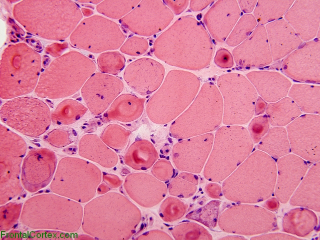 Ring fibers, H&E stain section