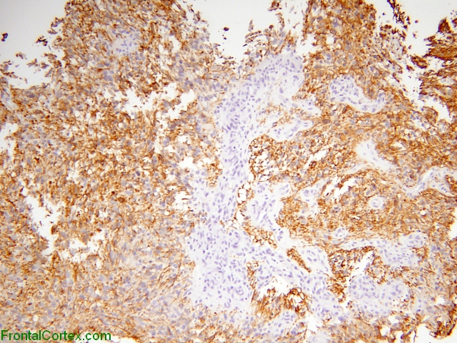 Glioblastoma multiforme, spinal metastasis, GFAP immunohistochemical staining.