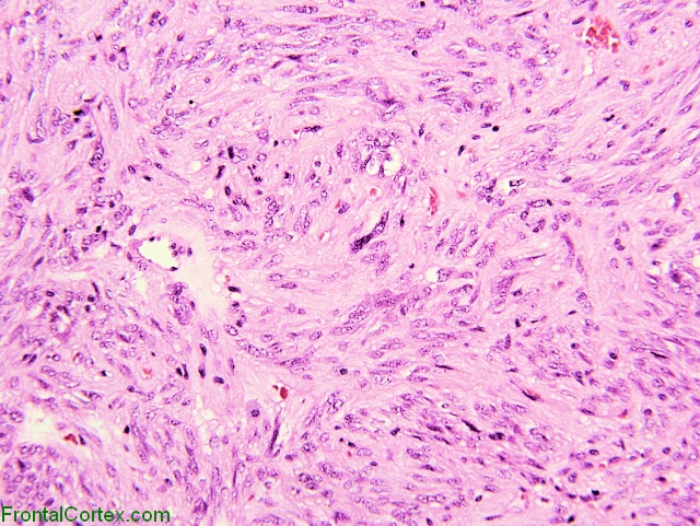 Spindle Cell Oncocytoma 1