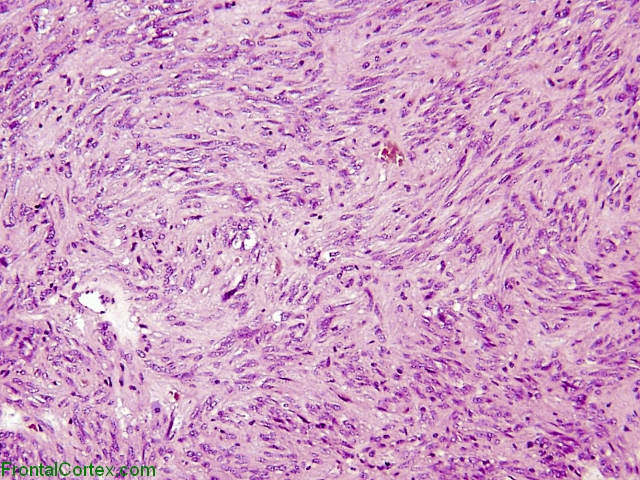 Spindle Cell Oncocytoma H&E