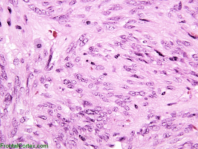 Spindle Cell Oncocytoma x400