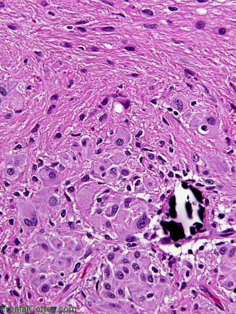 Subependymal Giant Cell Astrocyt