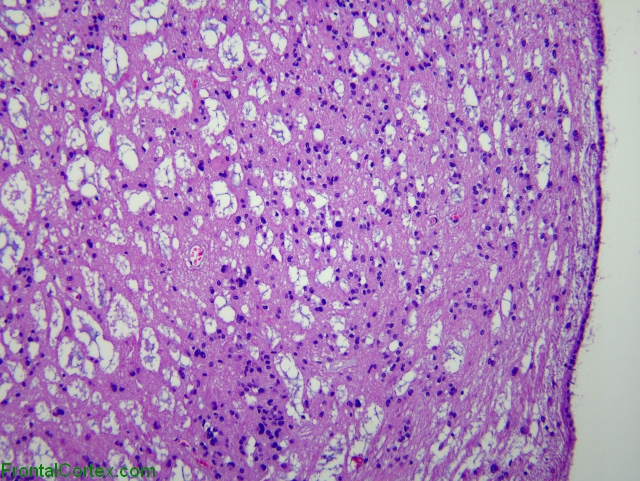 Subependymoma of lateral ventricle, H&E stain x 100