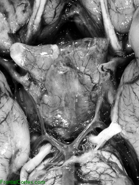 Suprasellar germinoma, ventral surface of brain, close-up.