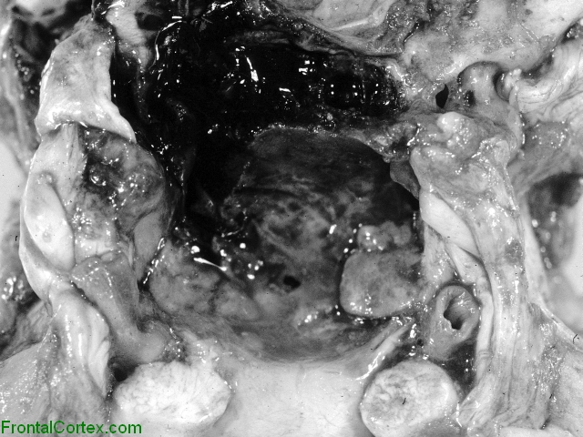 Metastatic malignant melanoma, suprasellar region, close-up