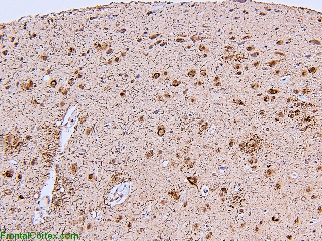 Surgical BX Ubiquitin IHC early