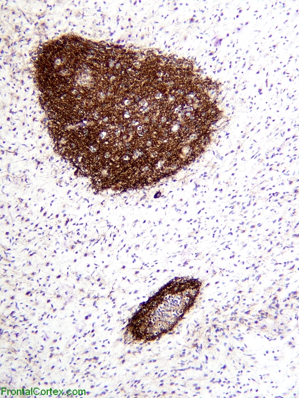 Glioneuronal Tumor with Neuropil Islands, synaptophysin immunohistochemical staining x 100