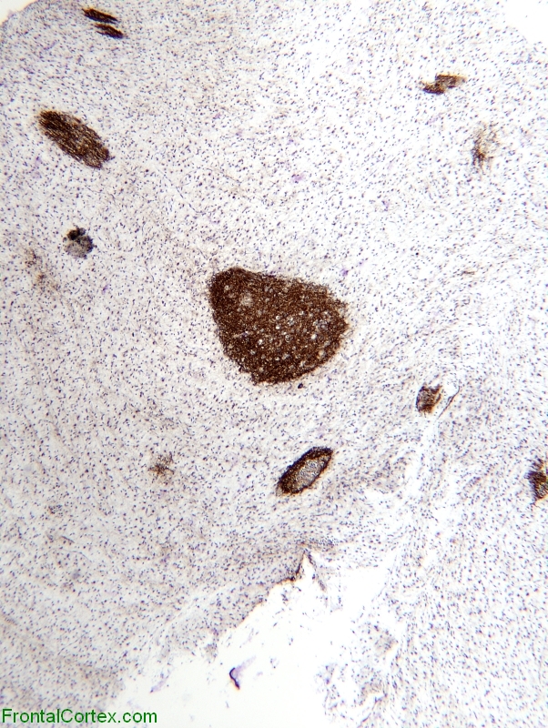 Glioneuronal Tumor with Neuropil Islands, synaptophysin immunohistochemical staining x 40