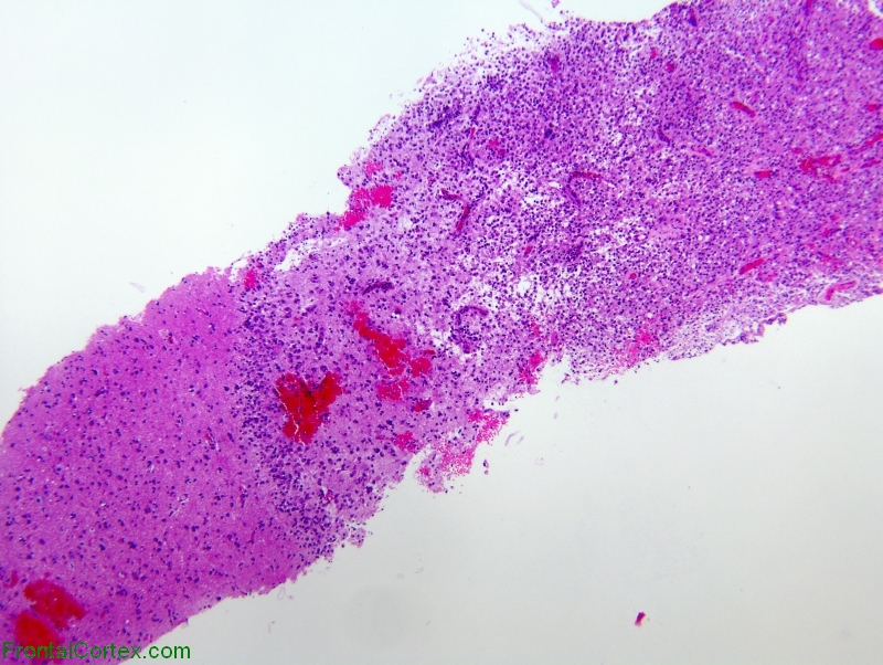 Stereotactic biopsy of tumefactive demyelinating lesion, H&E stain x 20