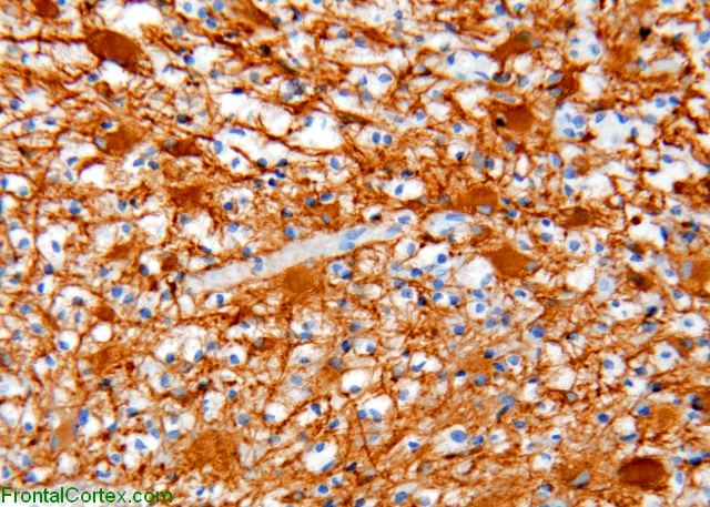 Tumefactive demyelination, immunohistochemical staining for glial fibrillary acidic protein