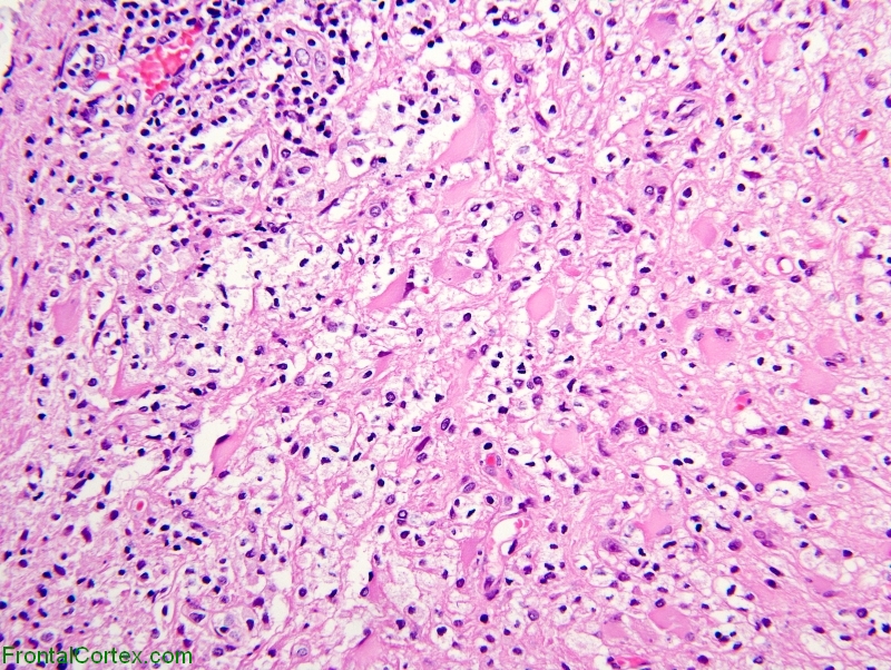 Tumefactive demyelination, low power H&E stain slide
