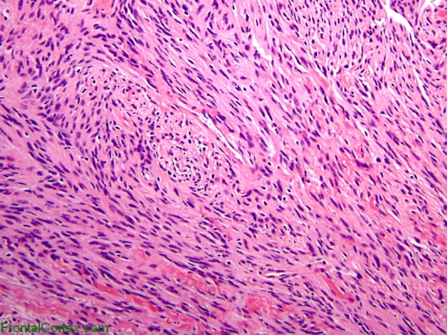 Tanycytic Ependymoma H&E