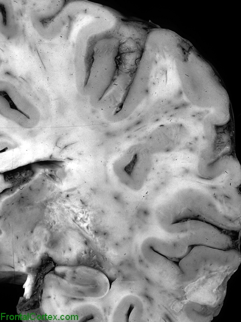 Cerebral toxoplasmosis, coronal section at the level of the thalamus