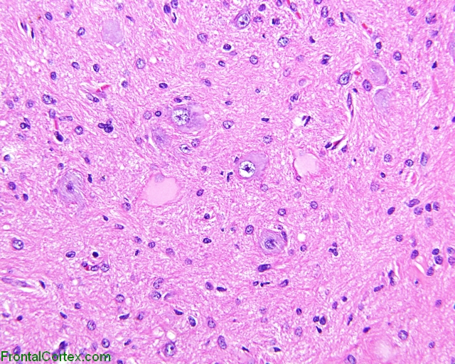 Cortical Tuber, medium-power hematoxylin and eosin stained section