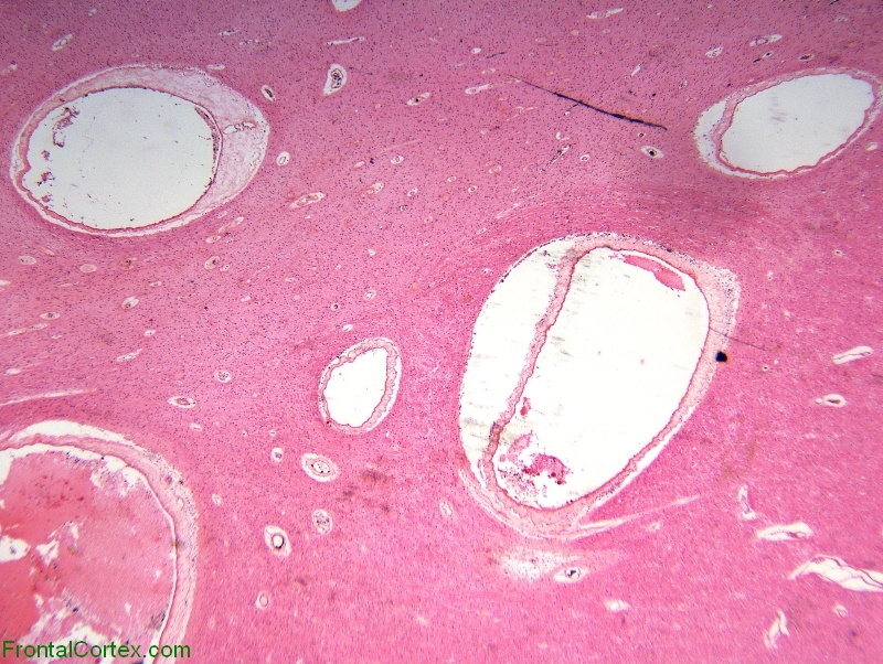 Venous angioma (malformation), H&E stain slide