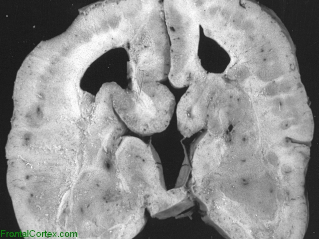 Subcortical band heterotopia, coronal section through brain