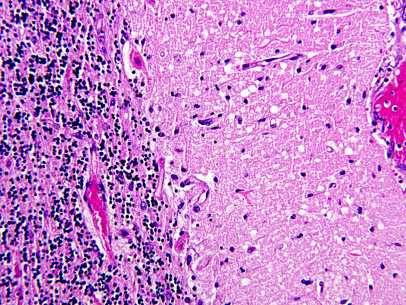 Acute neuronal necrosis - cerebellum