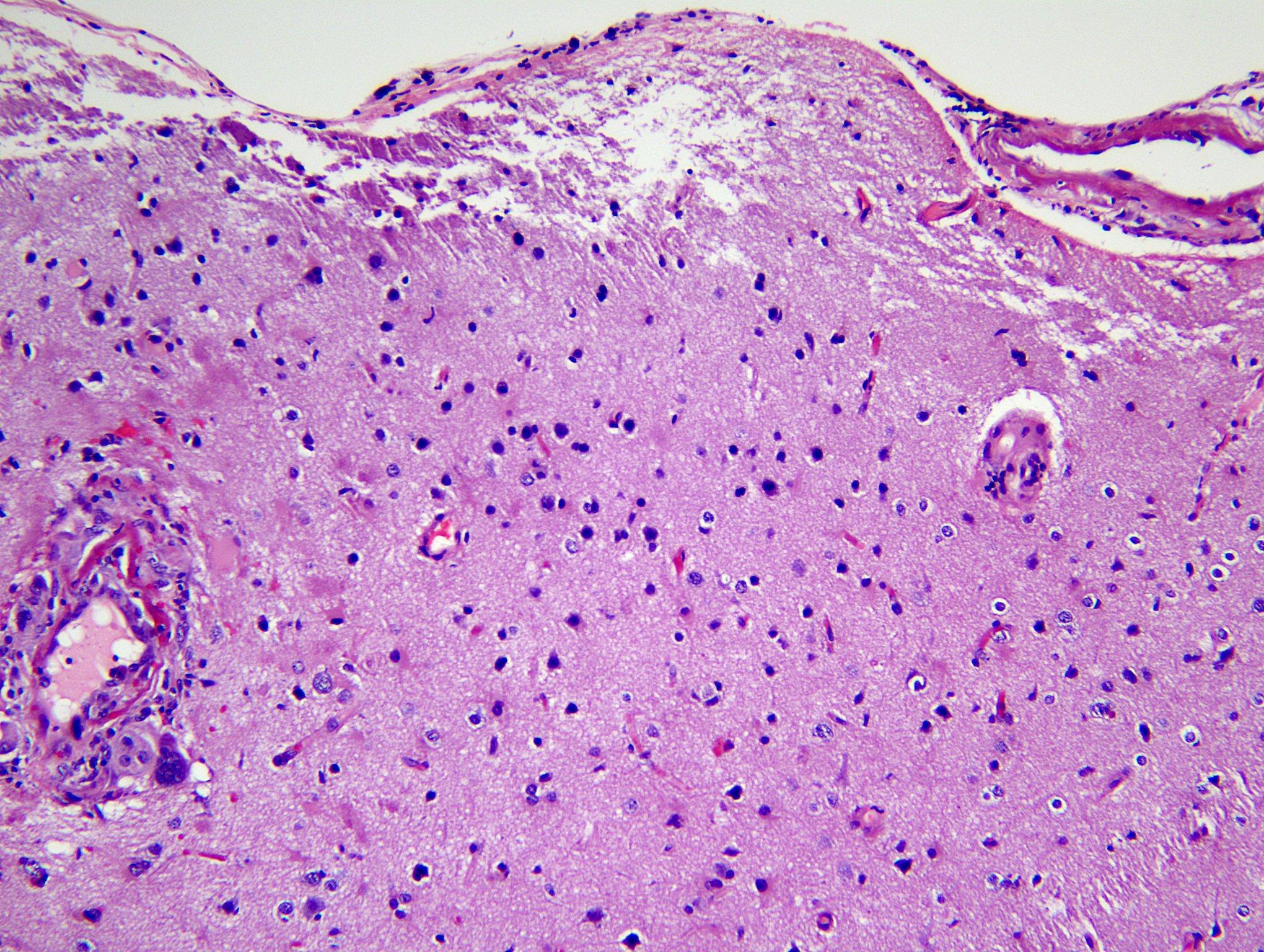  Amyloid beta related angiitis, H&E stained x 100