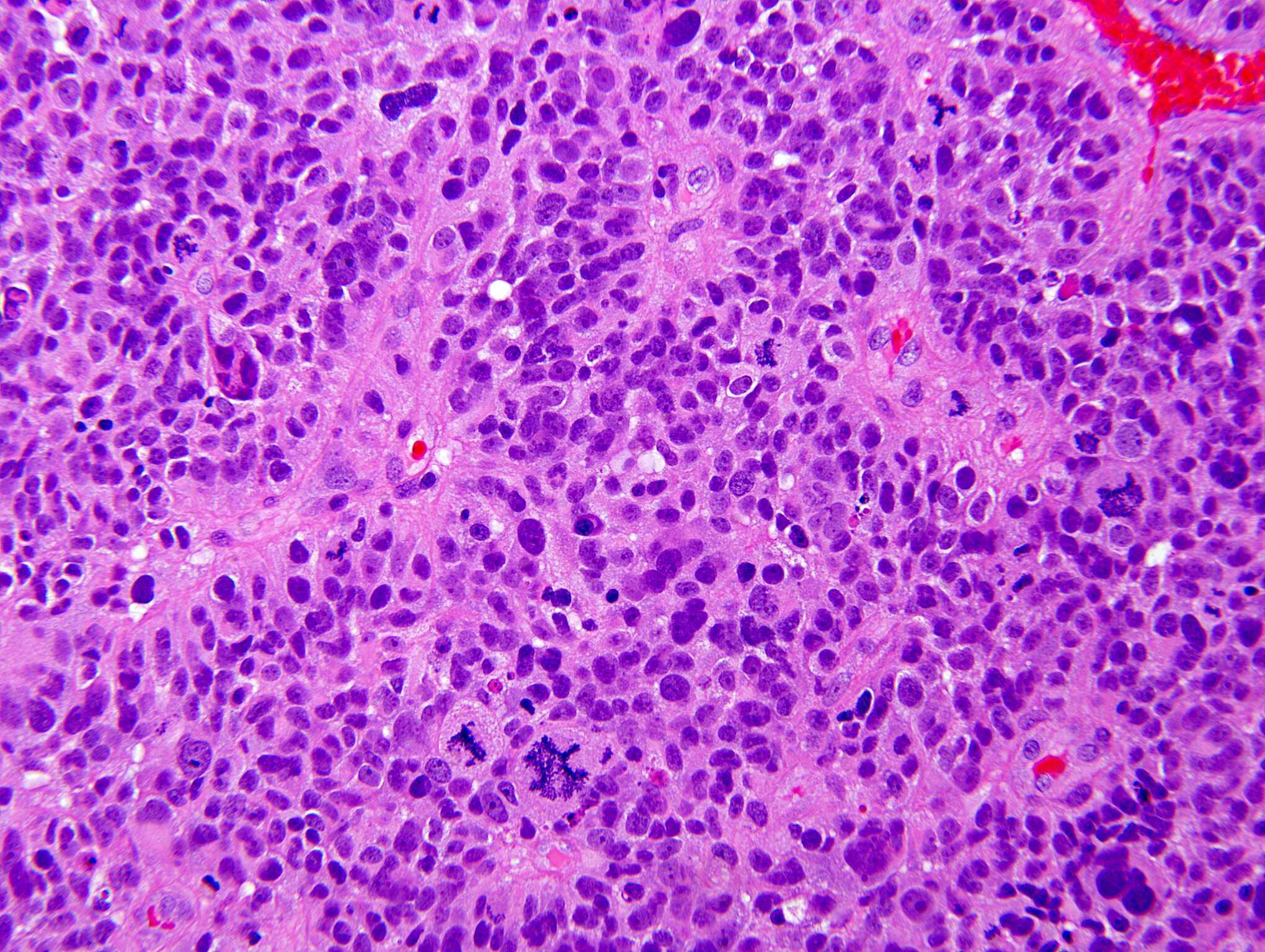 Anaplastic giant cell ependymoma, H&E stain x 200