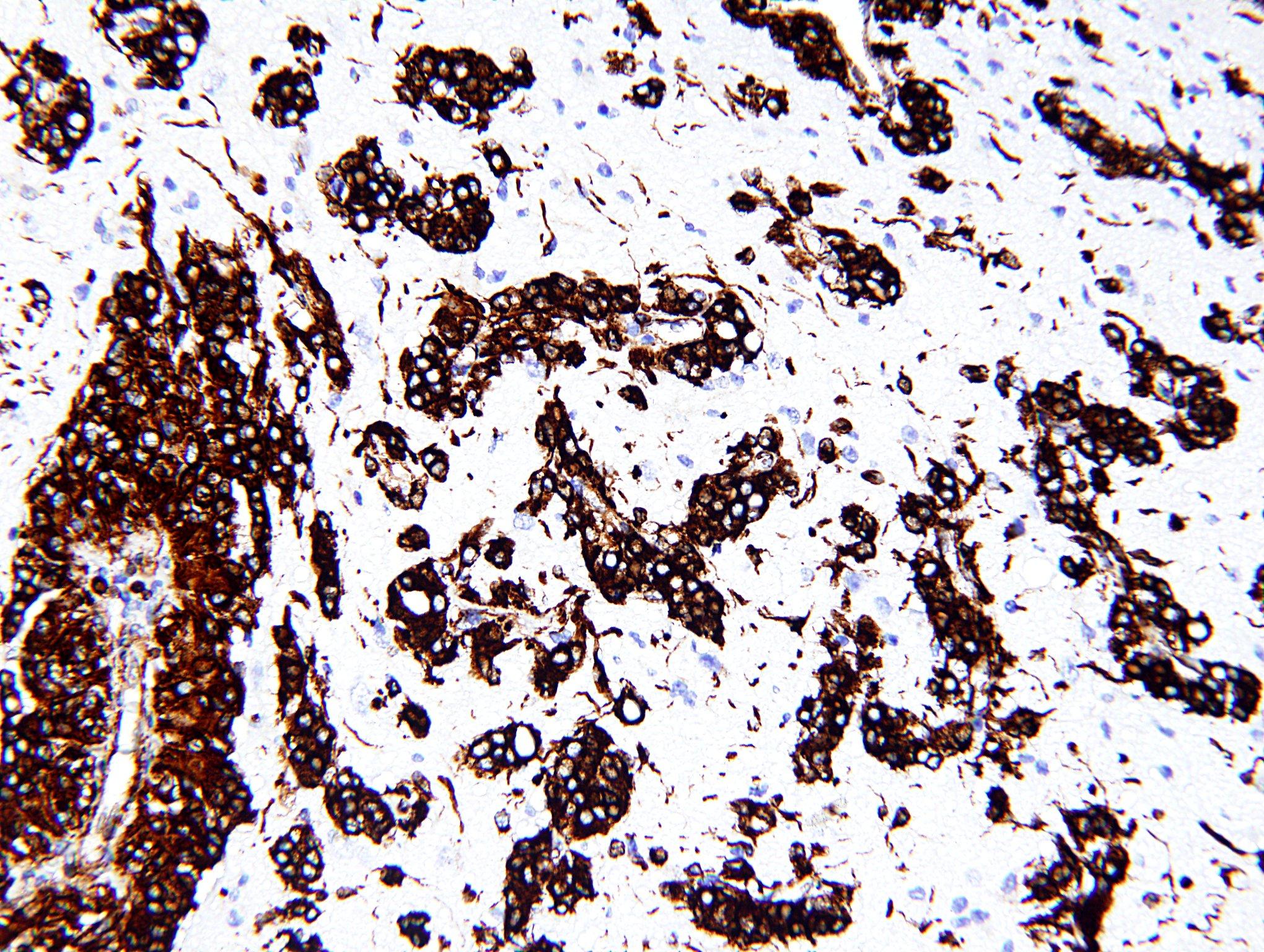 Angiocentric glioma, vimentin immunohistochemical staining