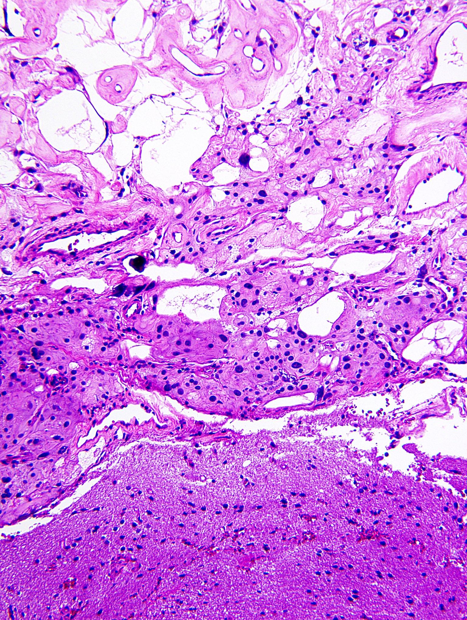 Microcystic meningioma with adherent brain parenchymal tissue