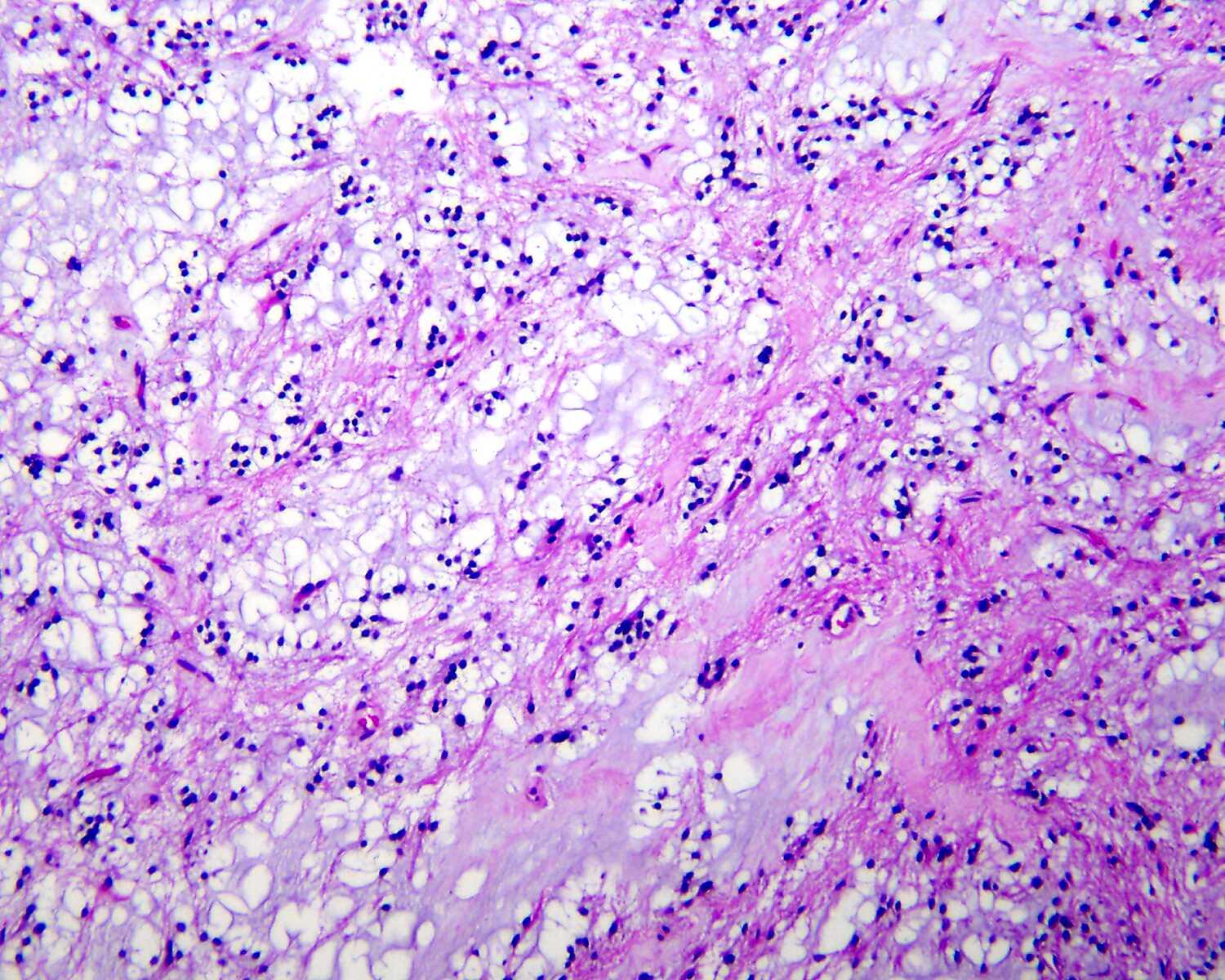 Rosetted glioneuronal tumor of t