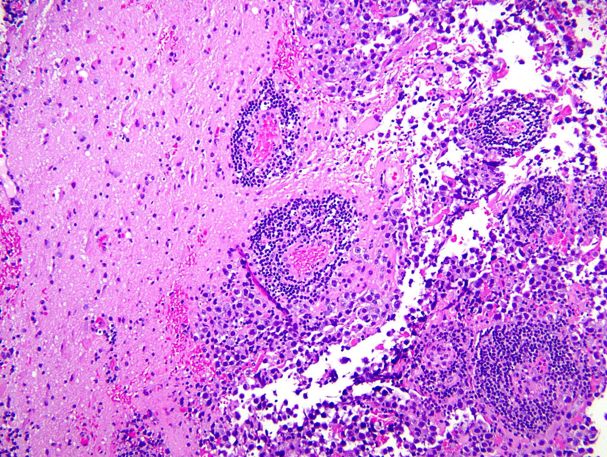 Basal ganglia germinoma, low pow