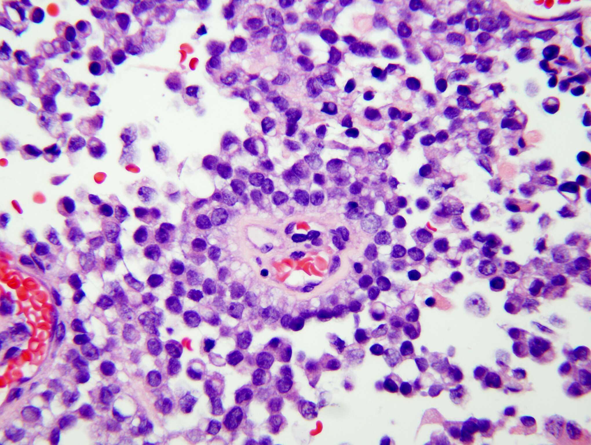 Papillary tumor of the pineal region, H&E stain x 400