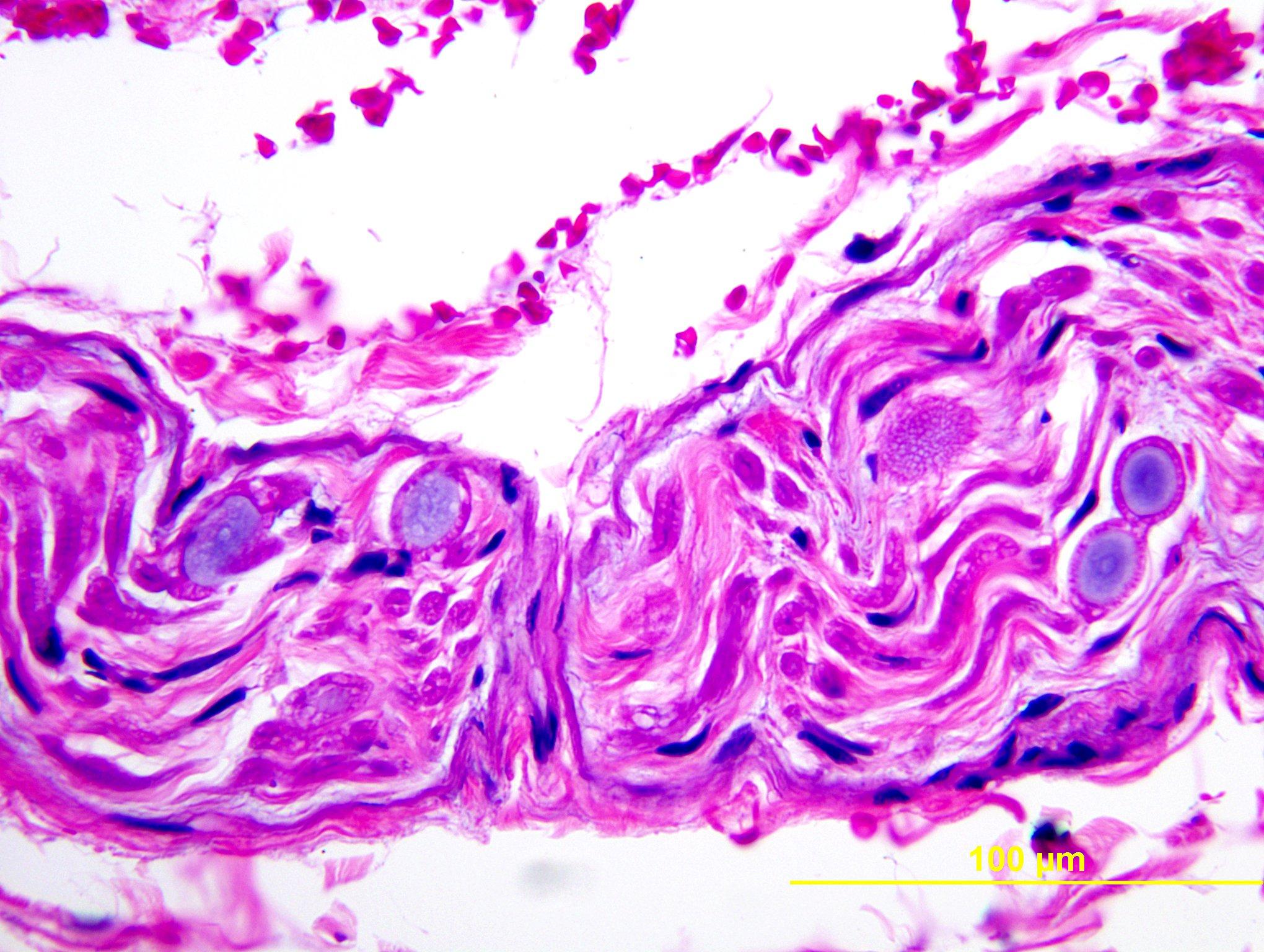 Polyglucosan body disease, intramuscular nerve twig, H&E stained x 400