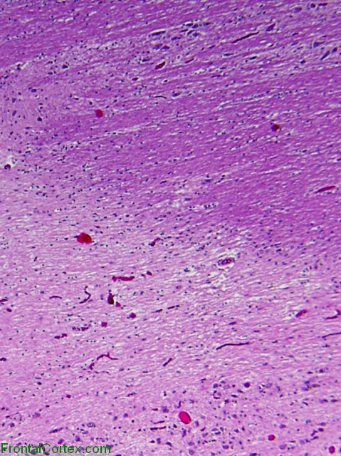 Inactive demyelinated plaque, H&E stain section