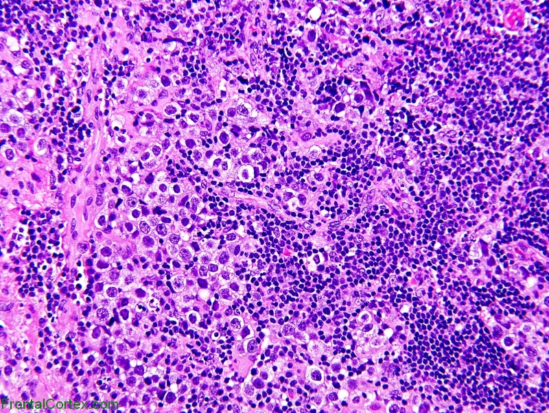 Pineal region germinoma, H&E stain x 200
