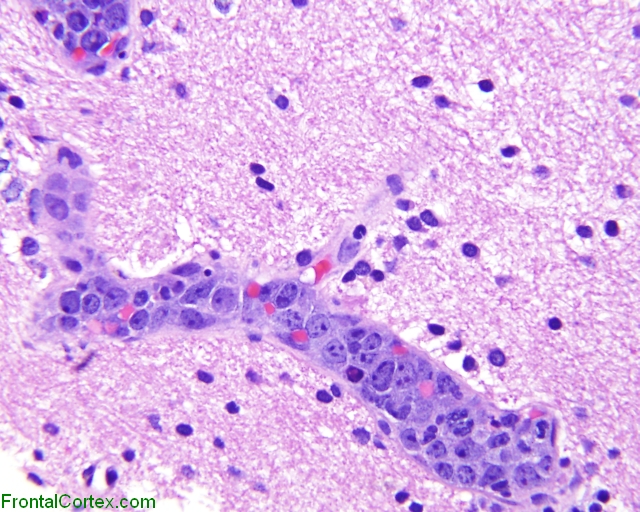 Intravascular lymphomatosis, stereotactic biopsy, H&E stain x 400