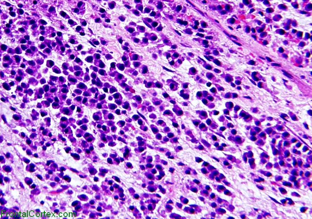 Plasmacytoma, H&E stained slide x 400