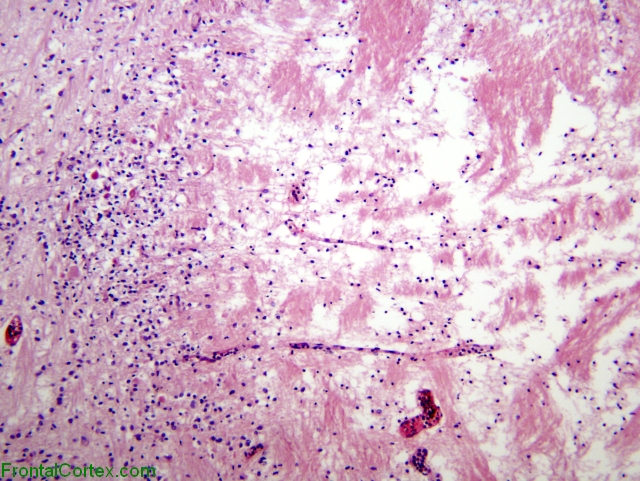 Periventricular leukomalacia, low-power H&E stained section