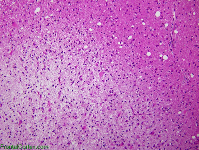 Tumefactive demyelination, low power H&E stained section